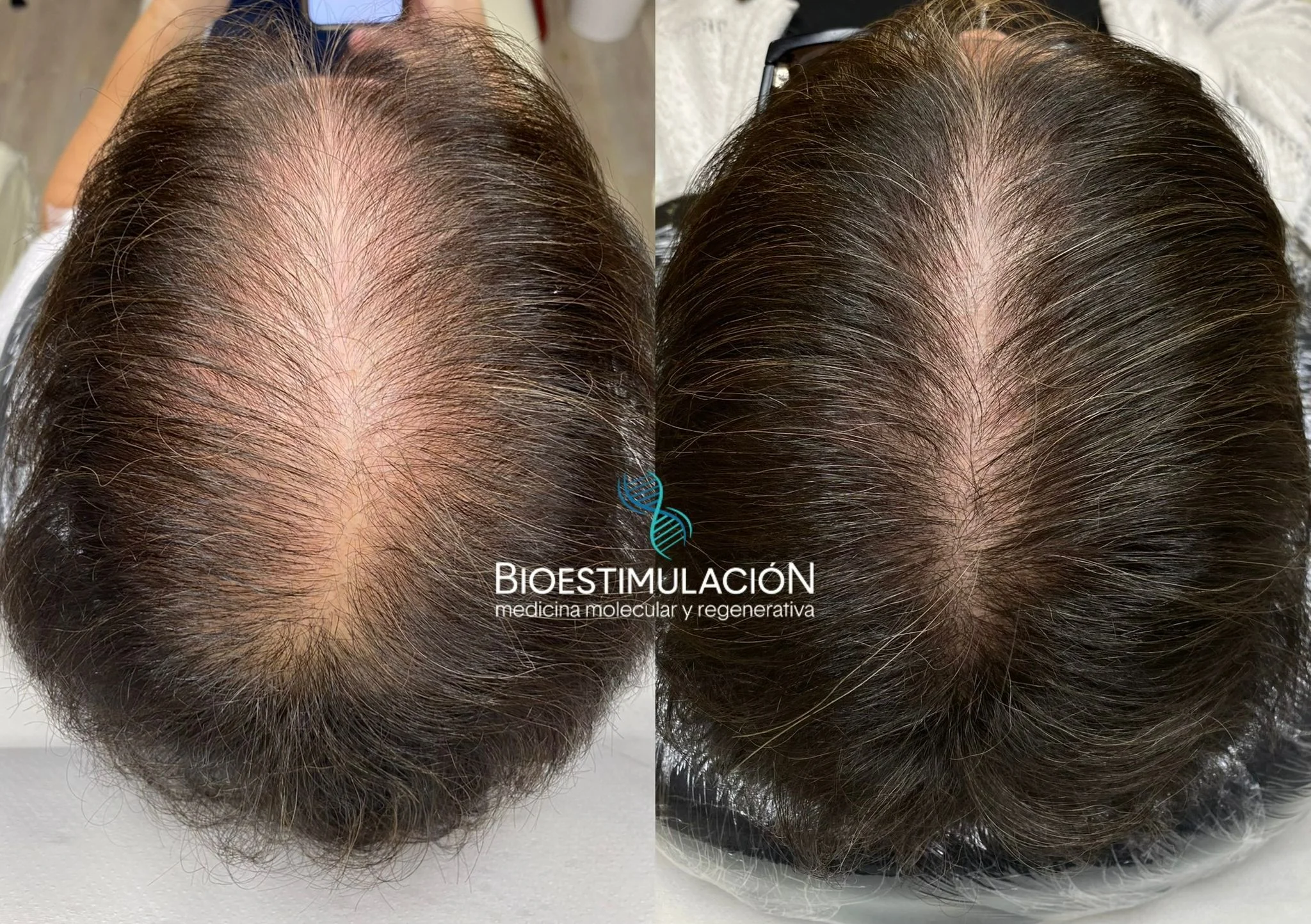 Resultado de recuperación capilar - Bioestimulación